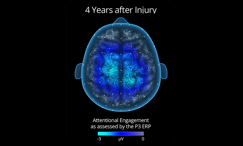 illustration of effects of concussion on cognition